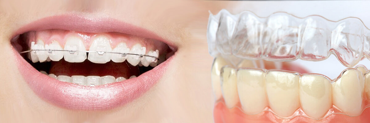 Why is Invisalign Faster than Braces? The Key to a Speedy Smile